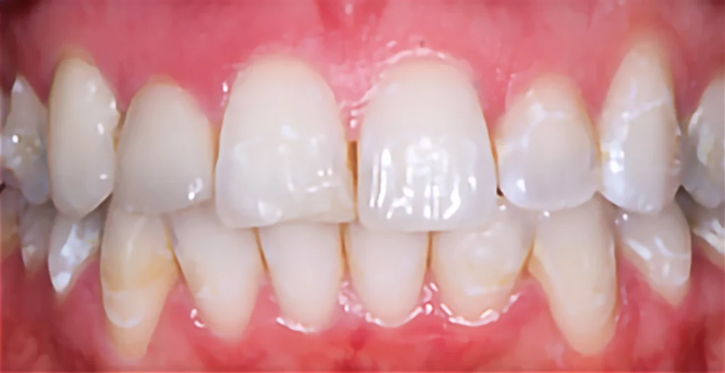 Veneer Case 1 (Before)