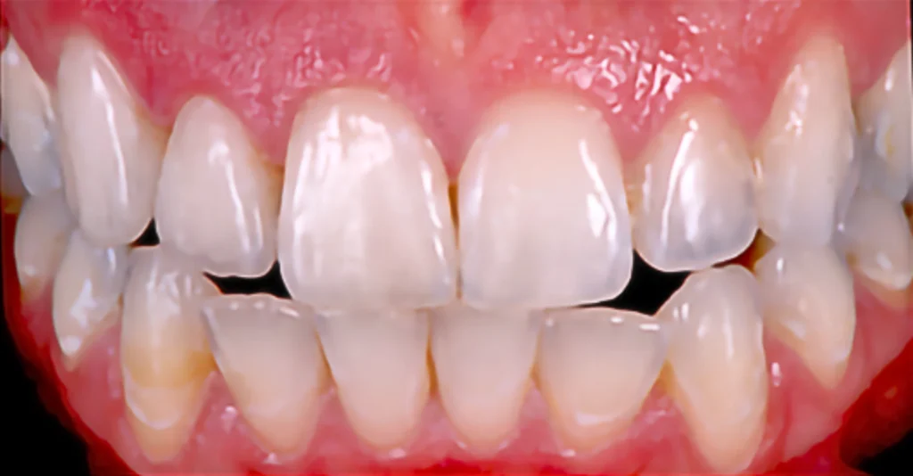 Veneer Case 1 (After)