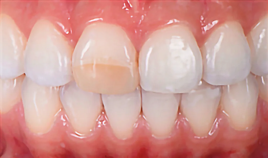 Veneer Case 2 (Before)