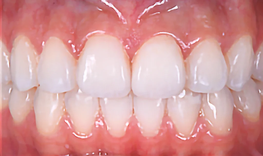 Veneer Case 2 (After)