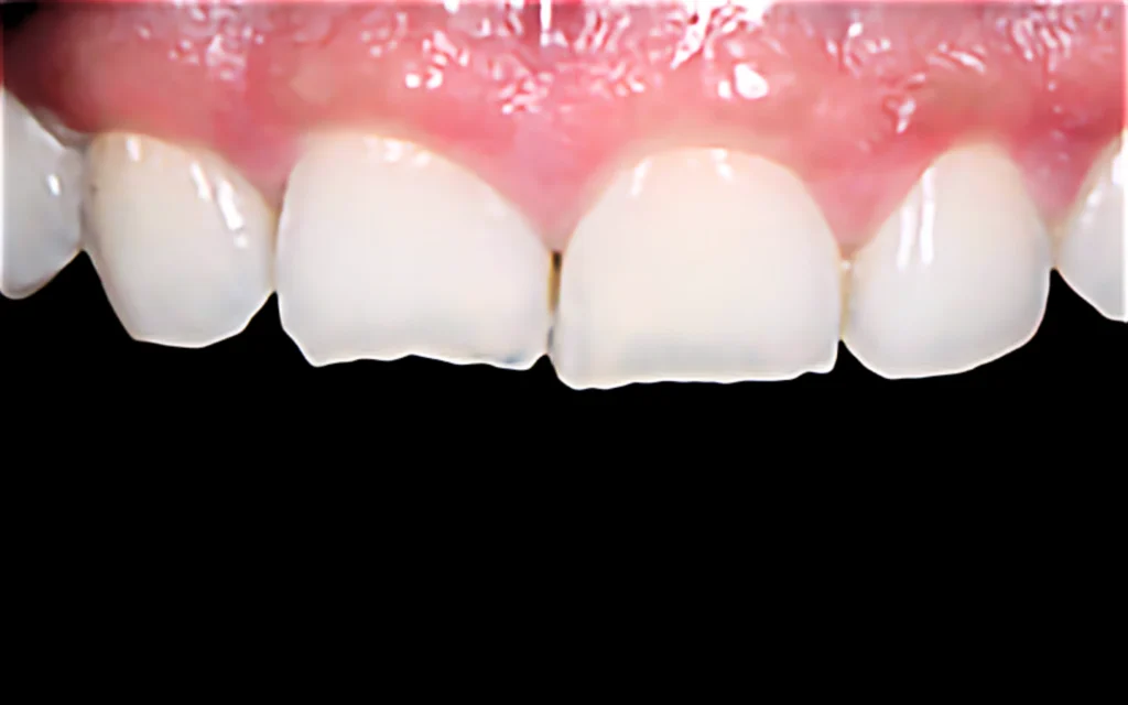 Veneer Case 3 (Before)