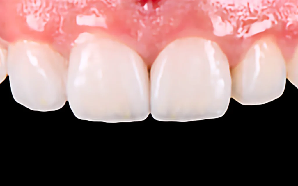 Veneer Case 3 (After)